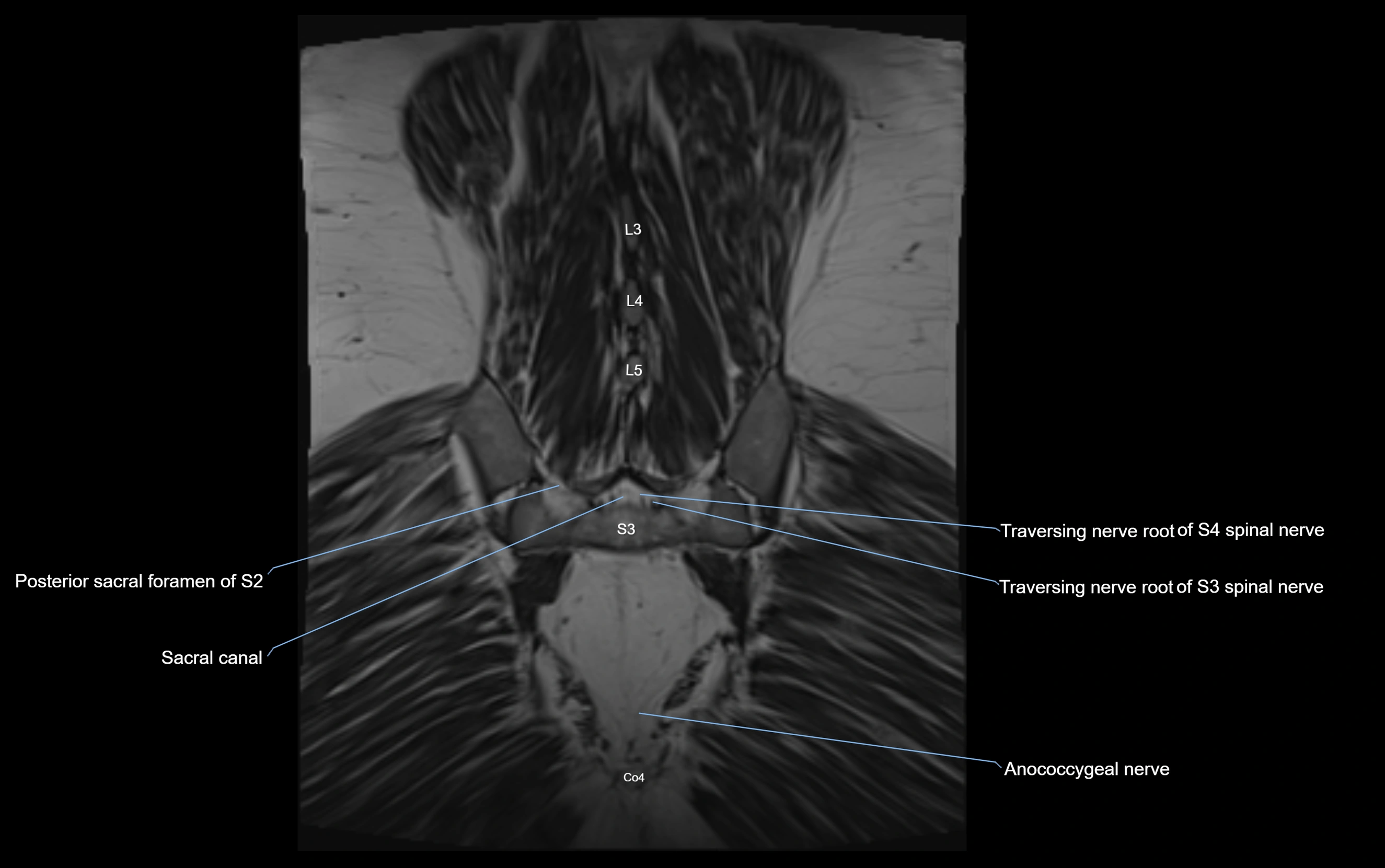 MR lumbosacral plexus cross sectional anatomy 3T  radiology  image-img-09001-00071.webp